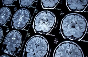 New Examine Hyperlinks Shingles to Cognitive Decline